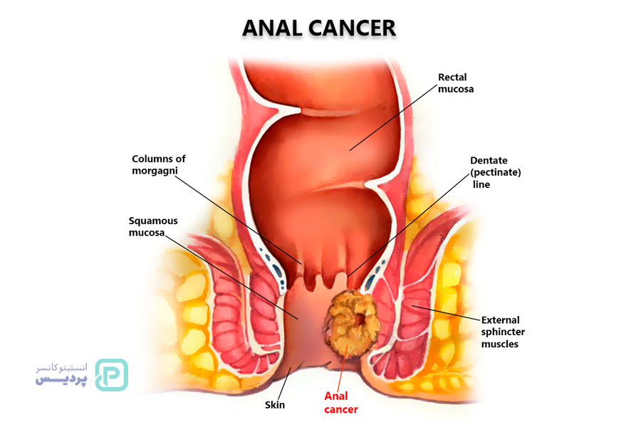 علائم سرطان مقعد
