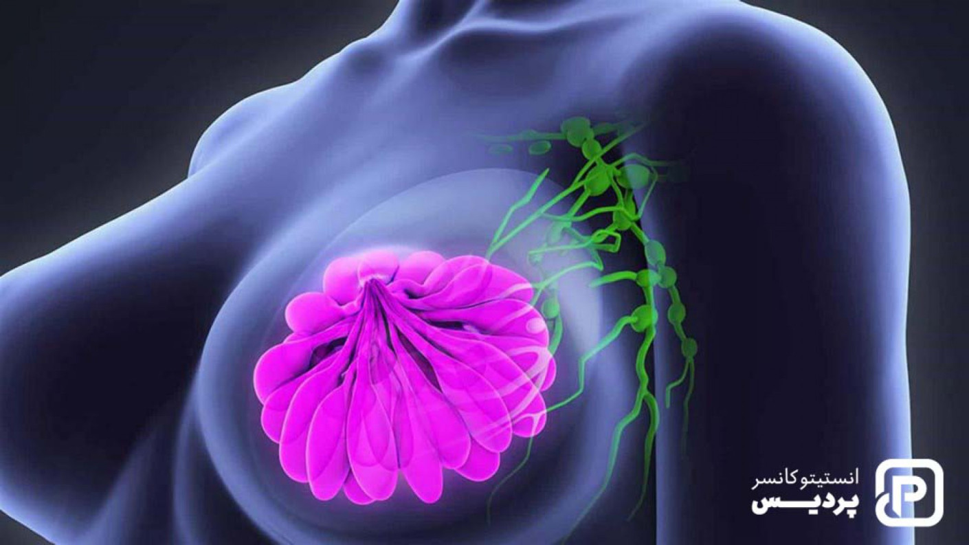 درجه بندی سرطان سینه چگونه است و چه معیارهایی دارد؟