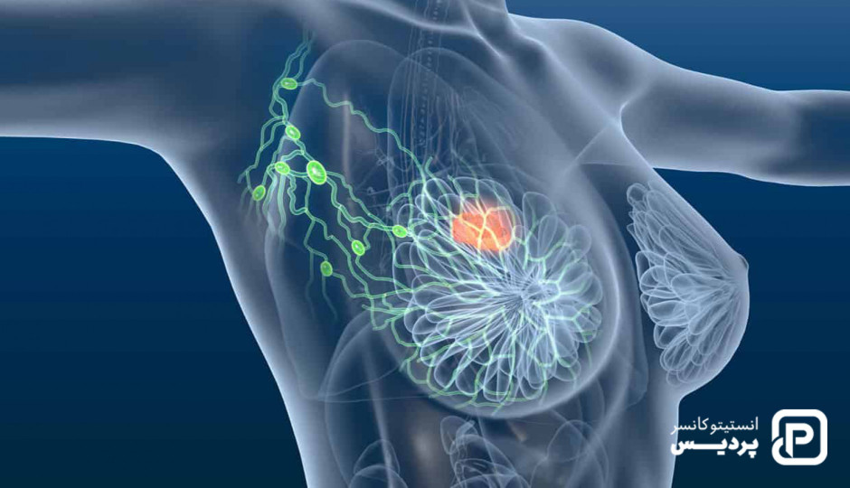 سرطان متاستاتیک سینه، علائم و نشانه ها و راههای درمان آن