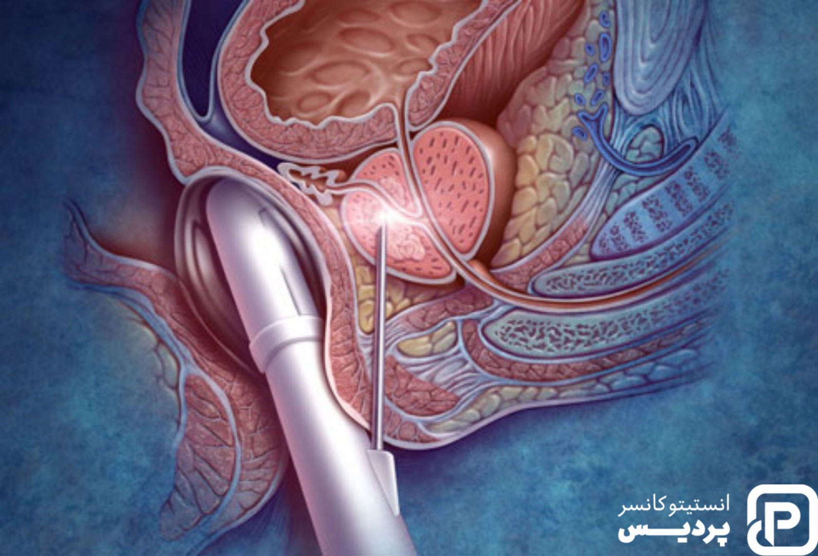 بیوپسی پروستات و تأثیر شگفت انگیز آن بر تشخیص سرطان پروستات - کلینیک پردیس