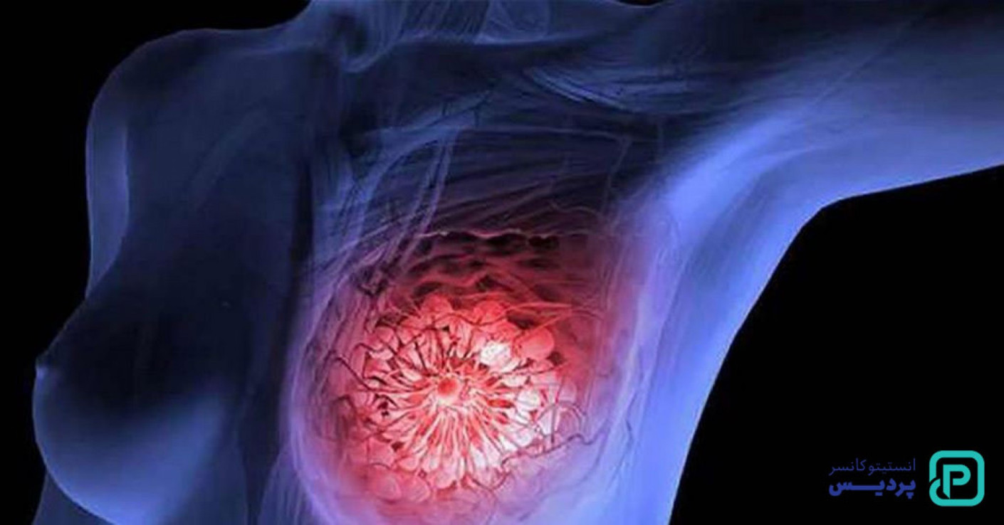 چه عواملی خطر ابتلا به سرطان سینه را افزایش می دهند