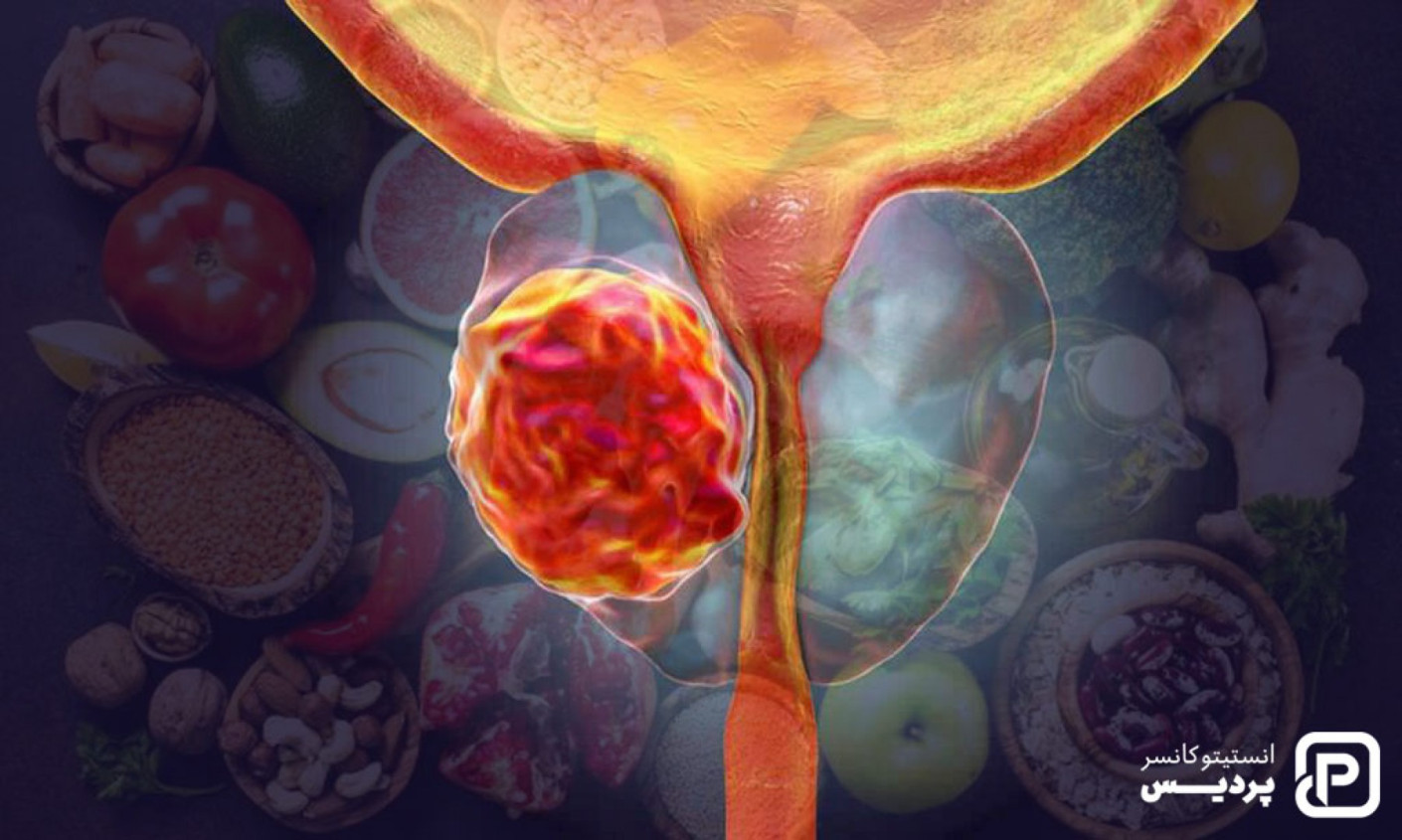 رژیم غذایی سالم و تأثیر آن بر پیشگیری ازسرطان پروستات 