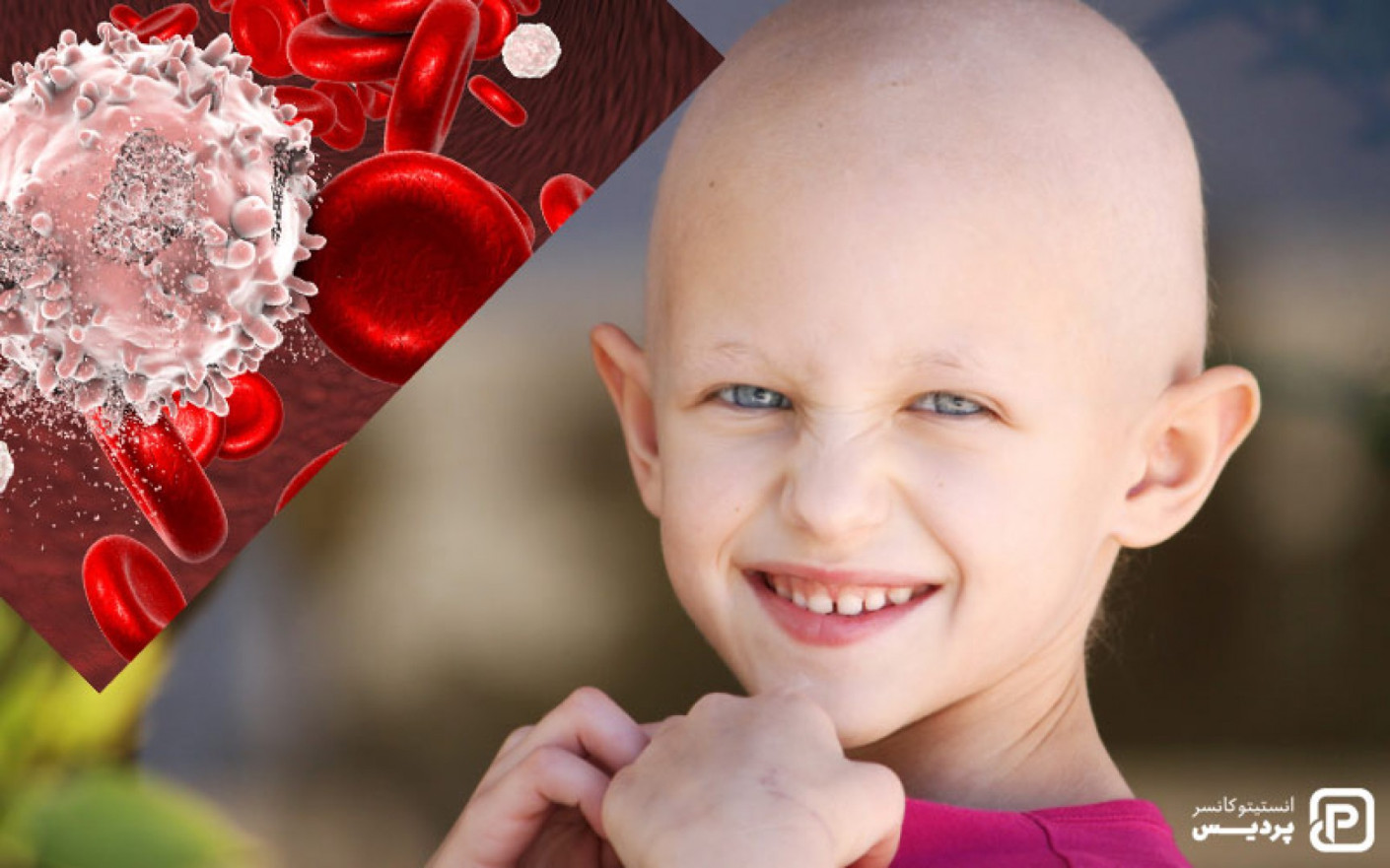با علائم و نشانه های سرطان خون در کودکان آشنا شوید