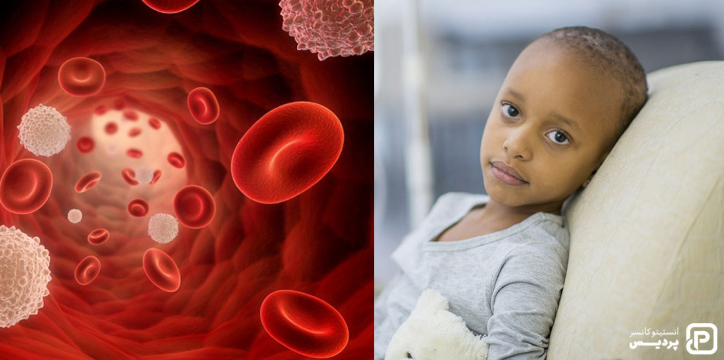 روش های درمان سرطان خون در کودکان را بشناسید