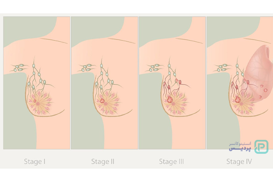 مرحله بندی سرطان سینه چگونه انجام می شود