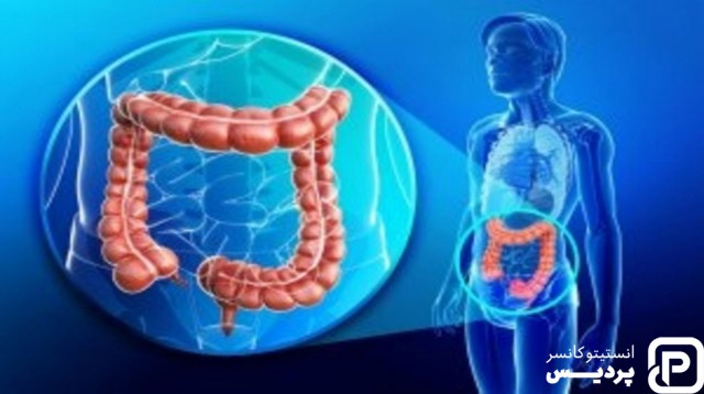سرطان روده بزرگ چگونه تشخیص داده می شود؟