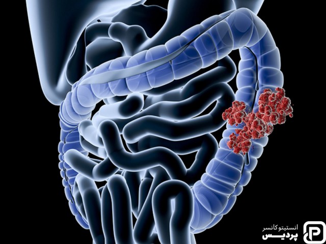 پیشرفت سرطان روده بزرگ چگونه اندازه گیری می شود؟