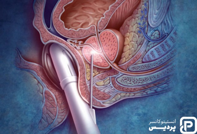 بیوپسی پروستات چیست و به چه منظور انجام می شود؟