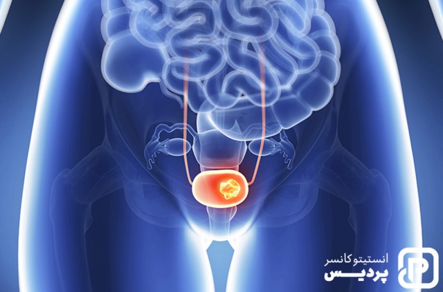 همه چیز در مورد سرطان مثانه