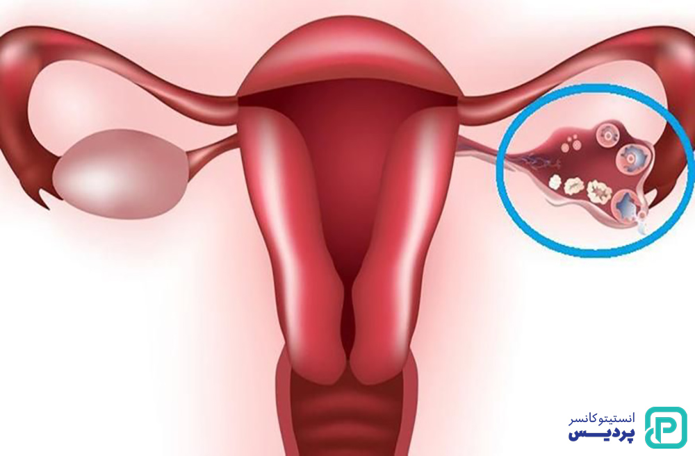 مرحله بندی سرطان تخمدان چگونه انجام می شود
