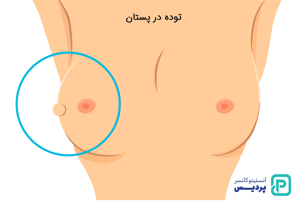 علائم و نشانه های سرطان پستان