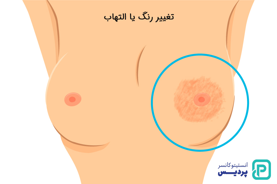 علائم سرطان پستان