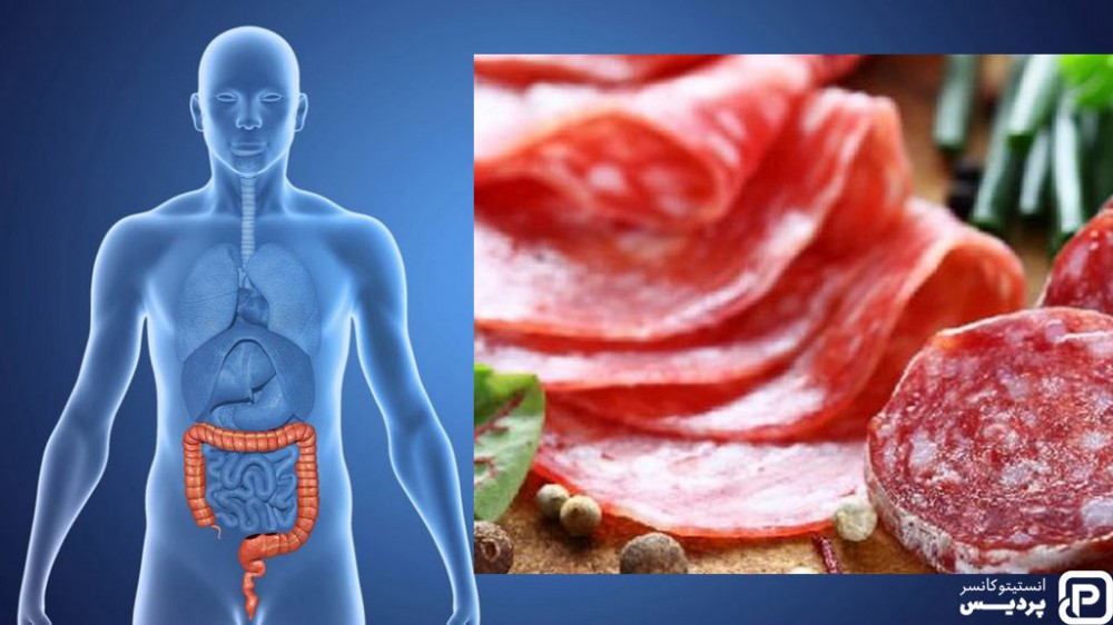 مصرف گوشت های فرآوری شده در رژیم غذایی سرطان روده بزرگ توصیه نمی شود
