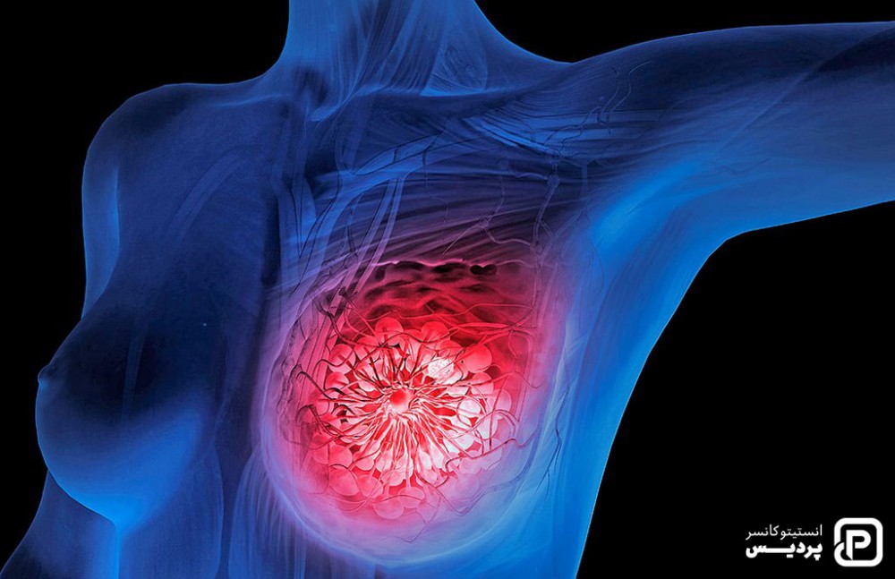علل بازگشت سرطان سینه به بدن چه مواردی هستند