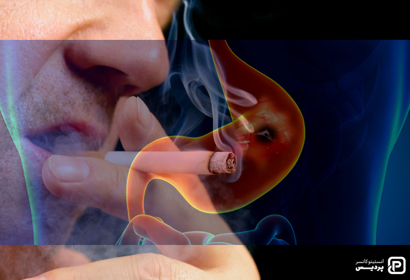 سو مصرف دخانیات و الکل از عوامل خطر سرطان معده