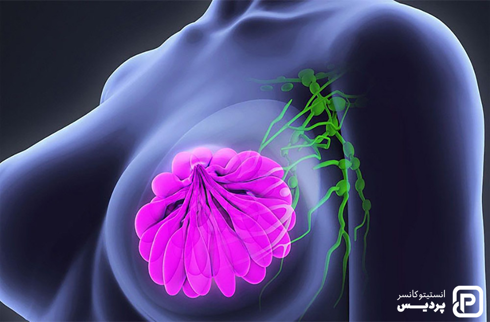 هر مرحله از سرطان سینه به چه معنی است