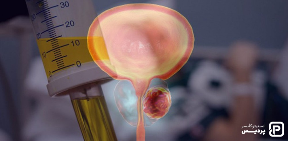 شیمی درمانی زمانی استفاده می شود که سلول های سرطانی به خارج از غده پروستات گشترس یافته باشند
