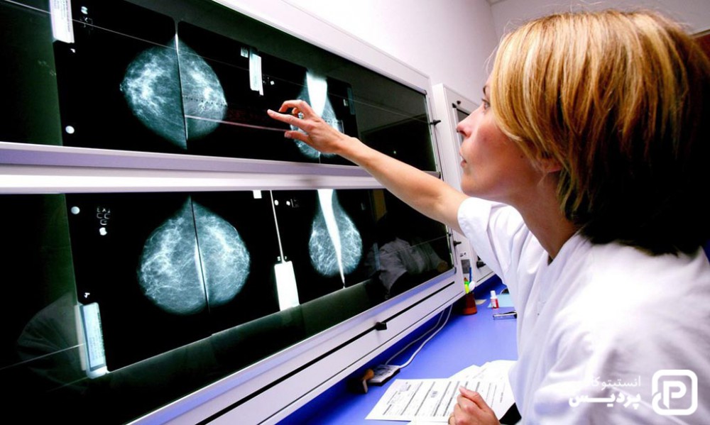سرطان متاستاتیک پستان
