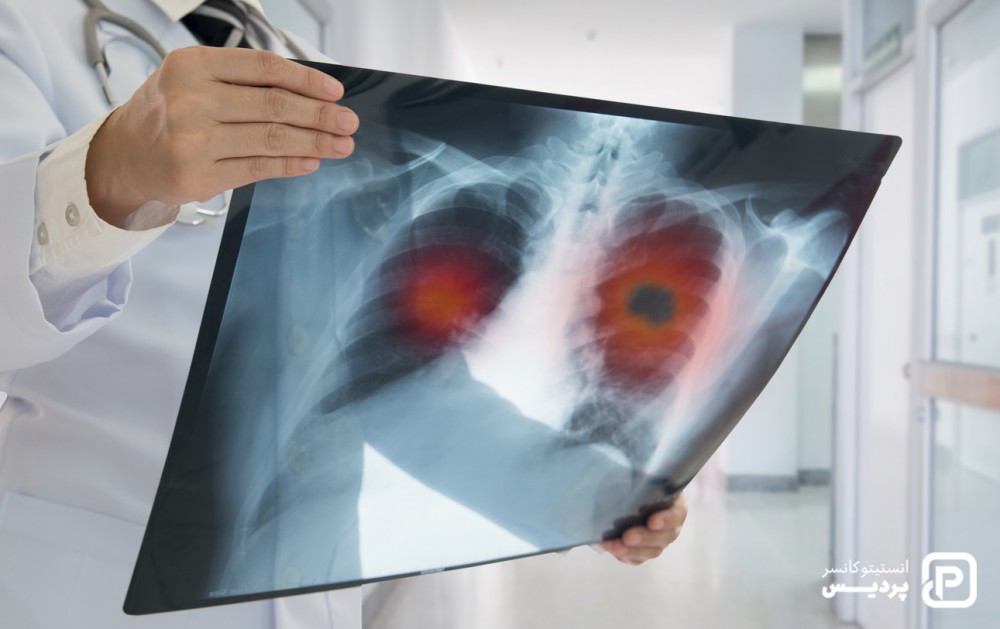 اشعه ایکس برای تشخیص سرطان