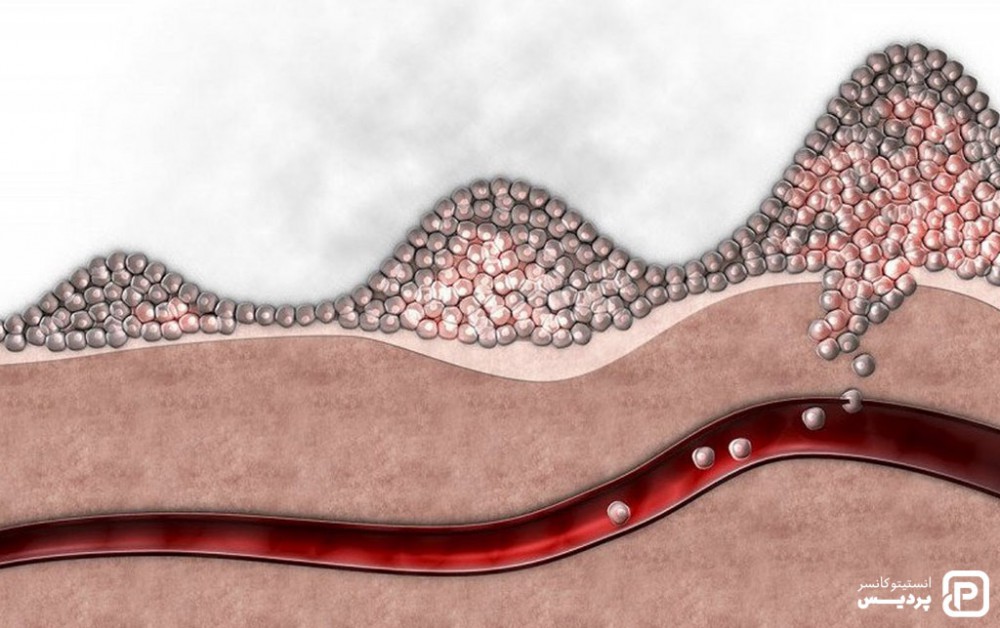 پخش شدن سرطان از طریق رگ های خونی