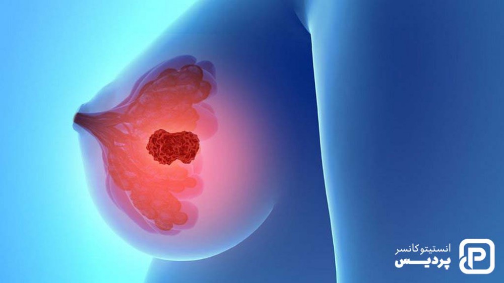 مرحله بندی سرطان سینه