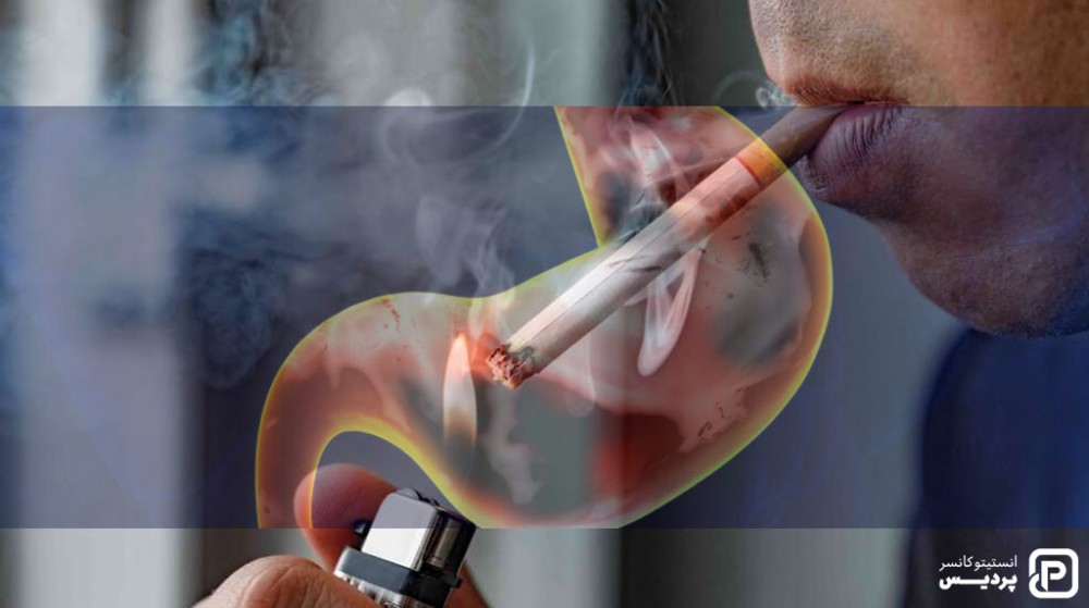 سیگار کشیدن از عوامل خطر سرطان معده می باشد