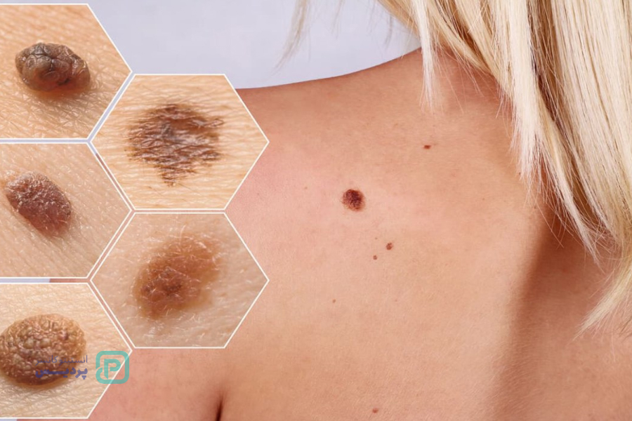 انواع سرطان: آشنایی با علائم، روشهای تشخیص و درمان 9 سرطان پوست