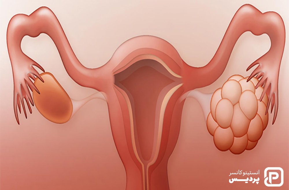 سرطان تخمدان را بیشتر بشناسید 6 درباره سرطان تخمدان بدانید
