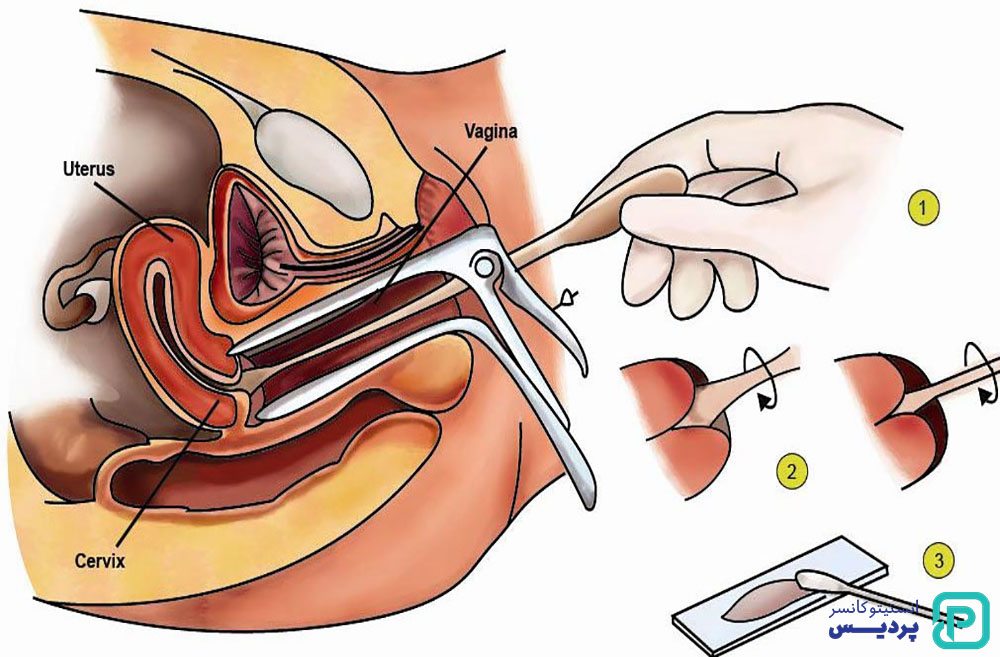 راه های تشخیص سرطان دهانه رحم