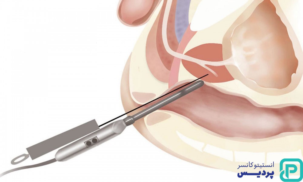 تشخیص به موقع سرطان پروستات