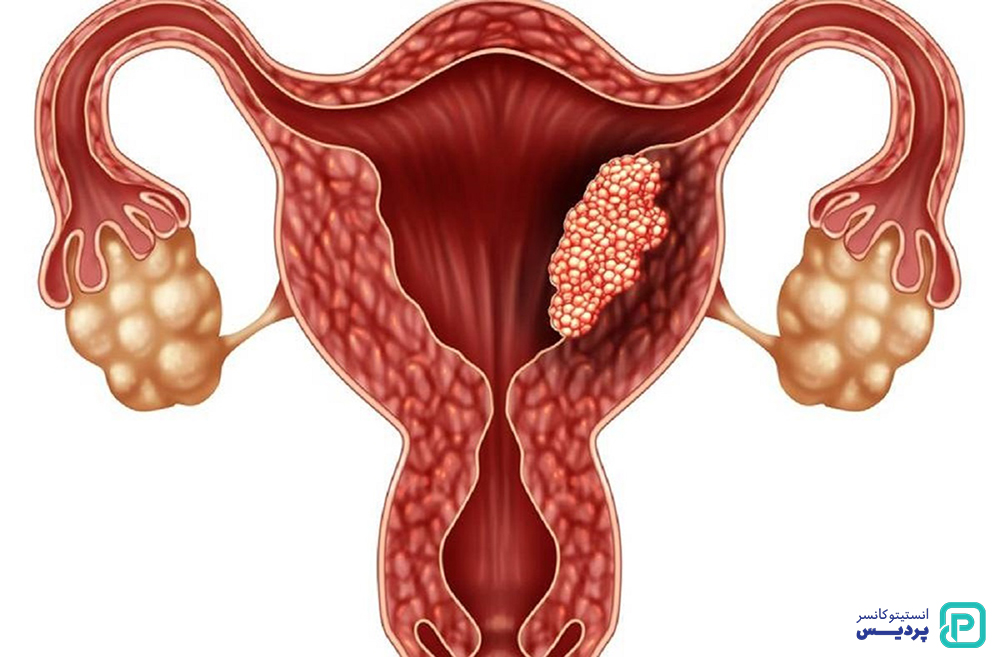 تشخیص سرطان دهانه رحم