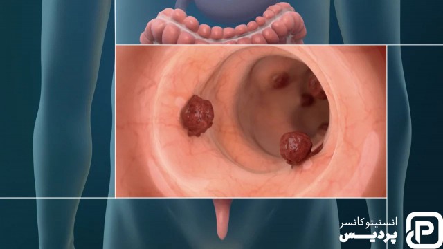 غربالگری سرطان کولورکتال