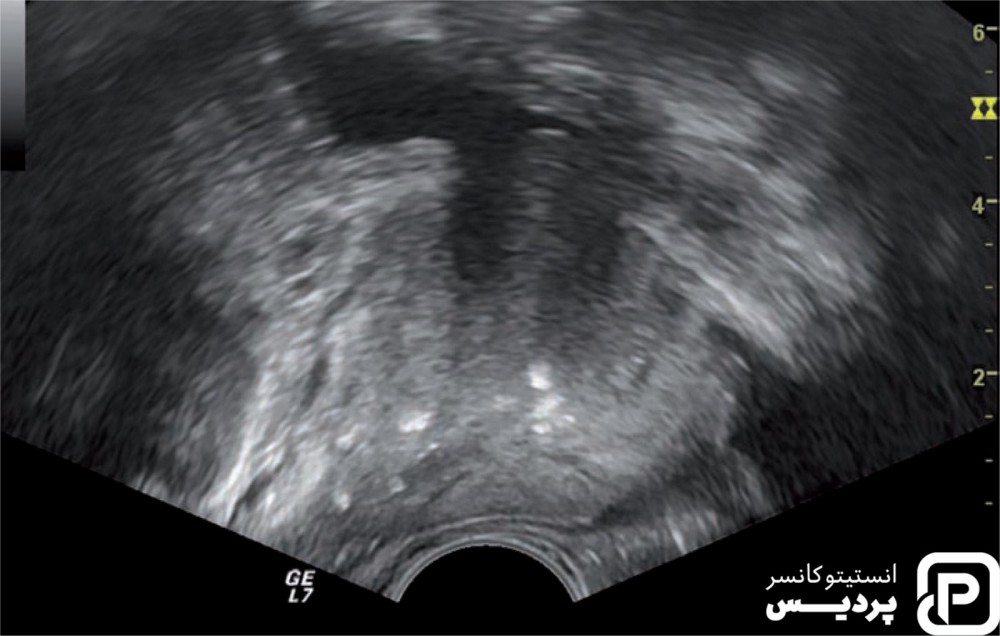 تشخیص به موقع سرطان پروستات