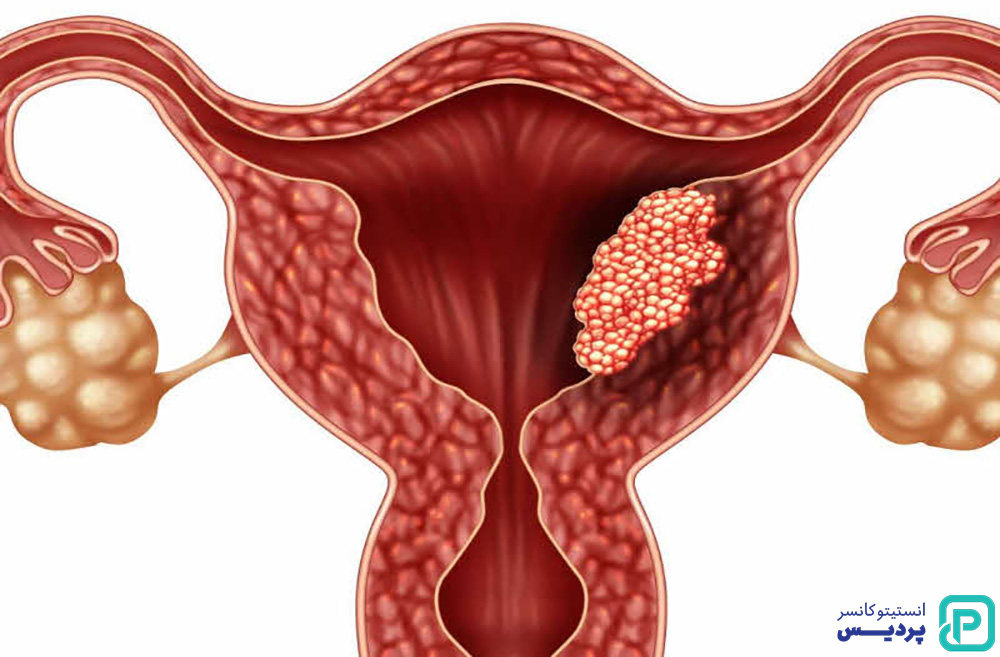 7 عامل افزایش خطر سرطان تخمدان 2 عوامل خطر سرطان تخمدان