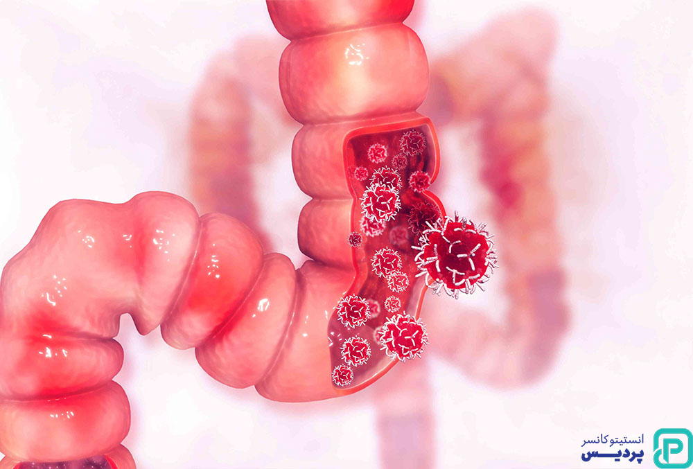 5 مورد از کشنده ترین سرطان ها 3 سرطان روده