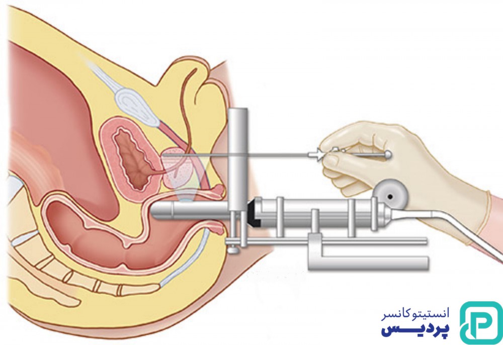 بیوپسی پروستات چیست و به چه منظور انجام می شود؟