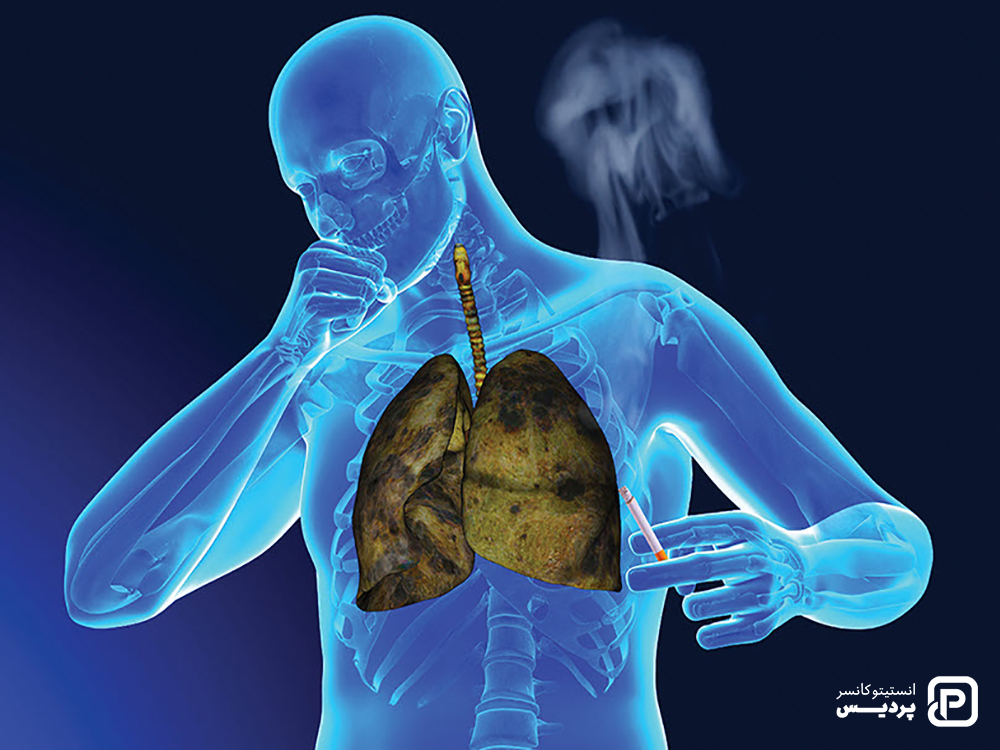 سرطان ریه چیست 3 انواع سرطان ریه