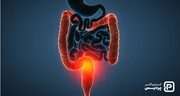 چه عواملی خطر ابتلا به سرطان روده بزرگ را افزایش می دهند