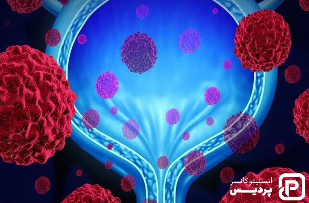 تشخیص سرطان مثانه با اسکن