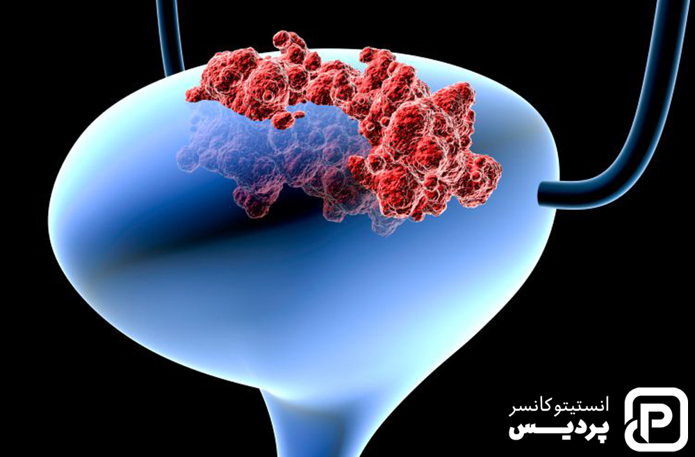 همه چیز در مورد سرطان مثانه 2 سرطان مثانه