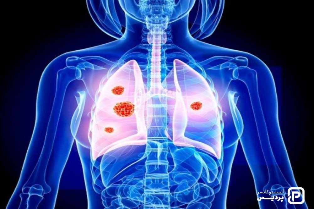 عوامل خطر سرطان ریه تغییر پذیر 