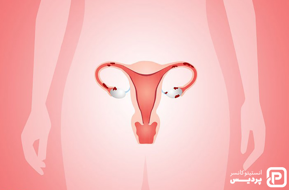 درمان سرطان دهانه رحم