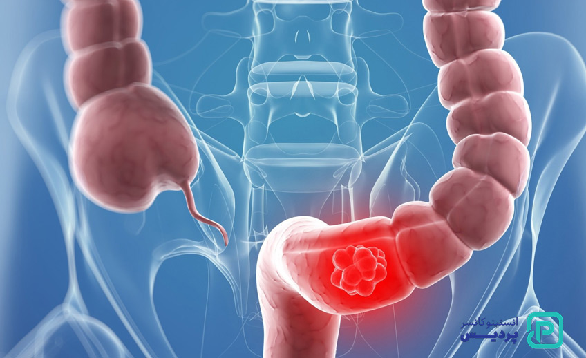 مصرف الکل از عوامل خطر سرطان روده بزرگ