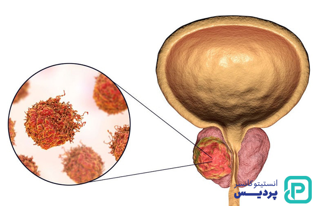 تشخیص سرطان مثانه چگونه است