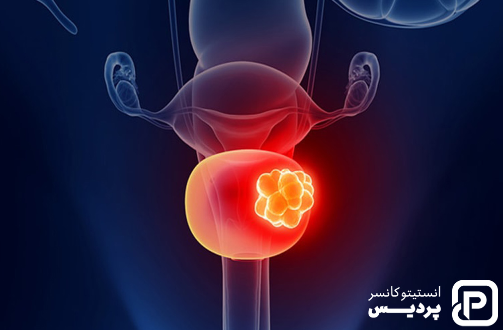 همه چیز در مورد سرطان مثانه 3 سرطان مثانه درمان