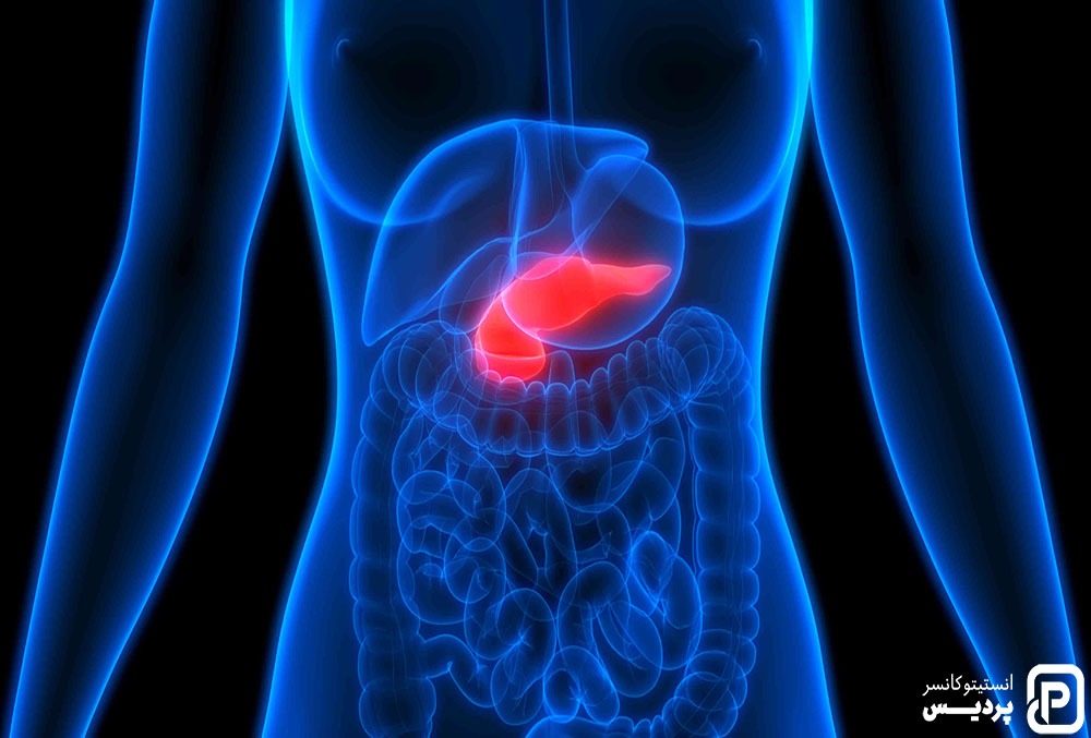 5 مورد از کشنده ترین سرطان ها 5 سرطان لوزالمعده