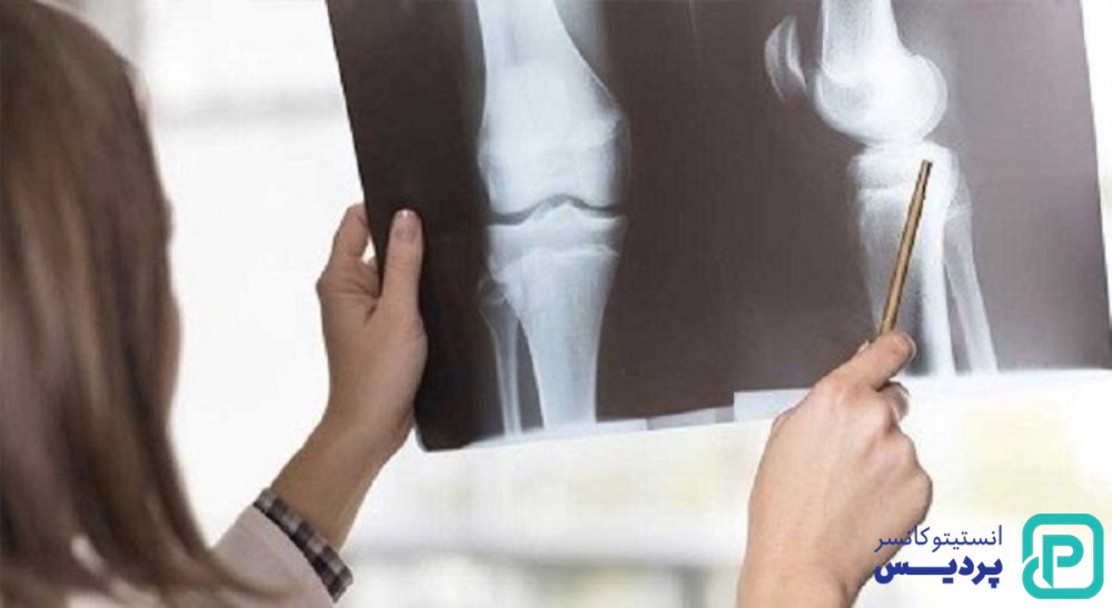 درمان سرطان استخوان