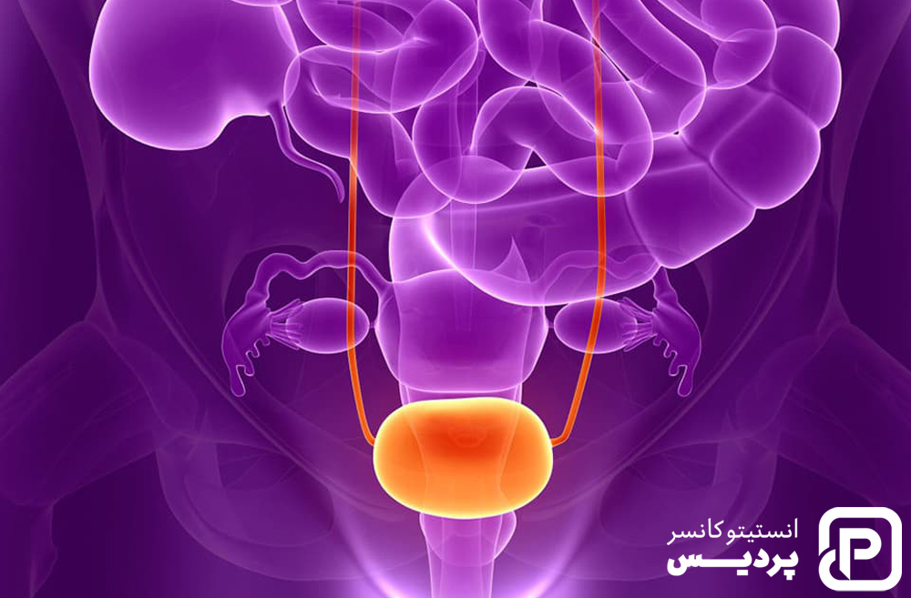 همه چیز در مورد سرطان مثانه 5 علائم سرطان مثانه