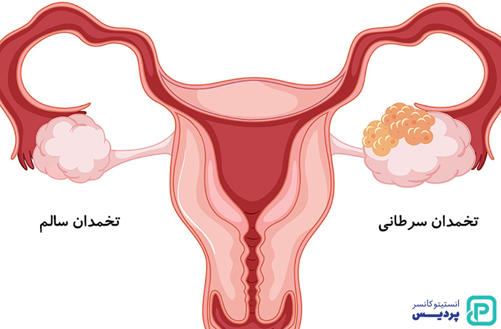 روش های درمانی سرطان تخمدان را بشناسید 2 سرطان تخمدان