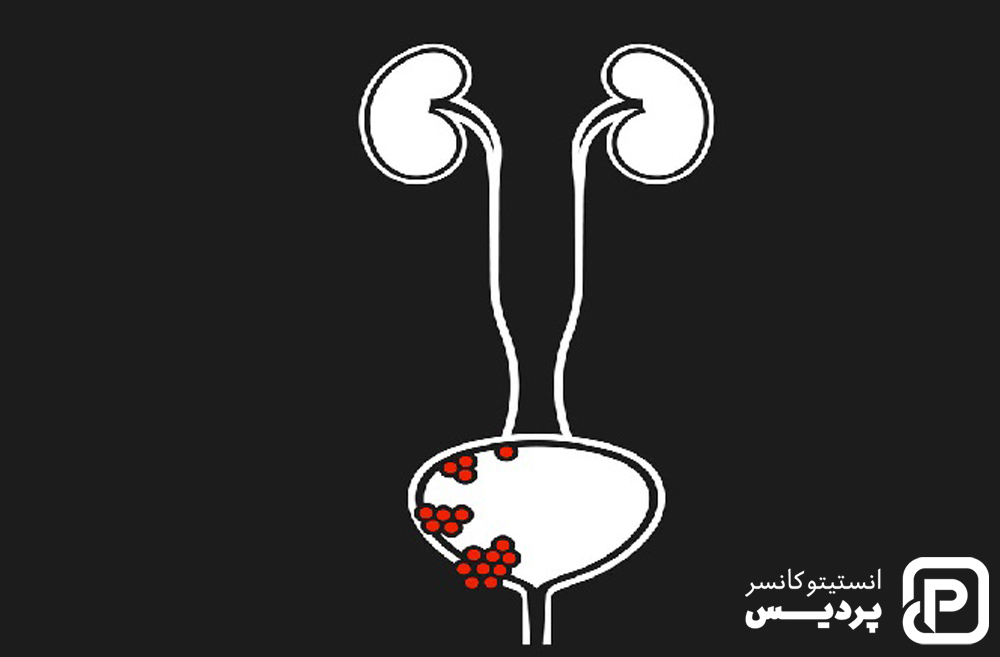 تشخیص سرطان مثانه به چه صورت است